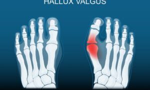 A Hallux Valgus