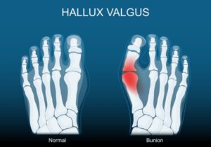 A Hallux Valgus