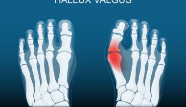 Een Hallux Valgus