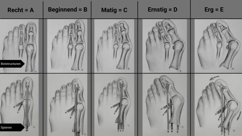 A Hallux Valgus