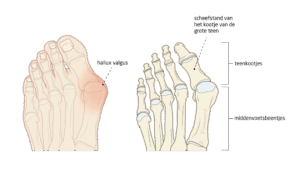 A Hallux Valgus