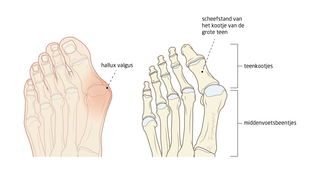 Een Hallux Valgus